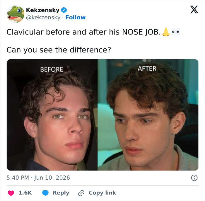 “Looksmaxxing” Attempt By Clavicular Torn Down By Netizens After He Shared Side-By-Side Results