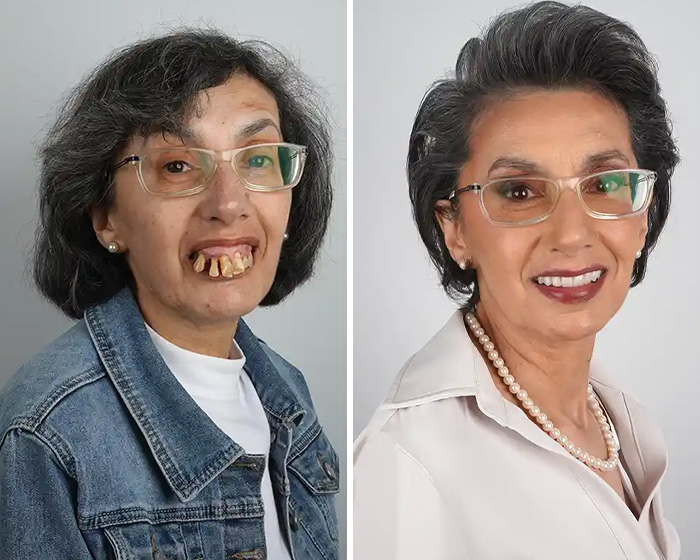 10 Jaw-Dropping Before-And-After Collages Of Women Who Underwent Extensive Smile Makeovers 10 Jaw-Dropping Before-And-After Collages Of Women Who Underwent Extensive Smile Makeovers