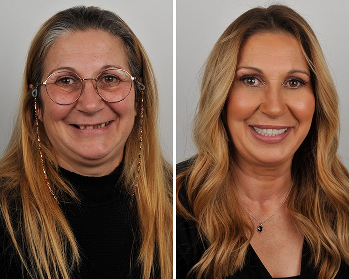 10 Jaw-Dropping Before-And-After Collages Of Women Who Underwent Extensive Smile Makeovers 10 Jaw-Dropping Before-And-After Collages Of Women Who Underwent Extensive Smile Makeovers