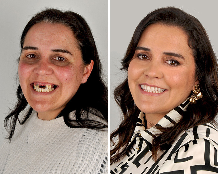 10 Jaw-Dropping Before-And-After Collages Of Women Who Underwent Extensive Smile Makeovers 10 Jaw-Dropping Before-And-After Collages Of Women Who Underwent Extensive Smile Makeovers
