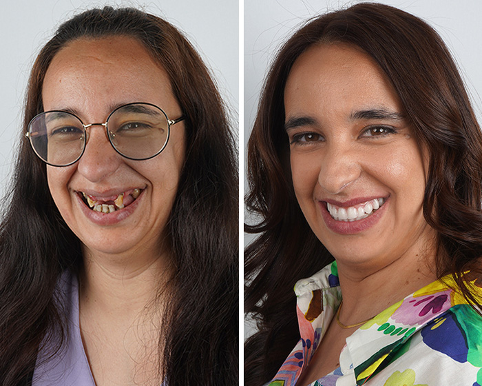 10 Jaw-Dropping Before-And-After Collages Of Women Who Underwent Extensive Smile Makeovers 10 Jaw-Dropping Before-And-After Collages Of Women Who Underwent Extensive Smile Makeovers
