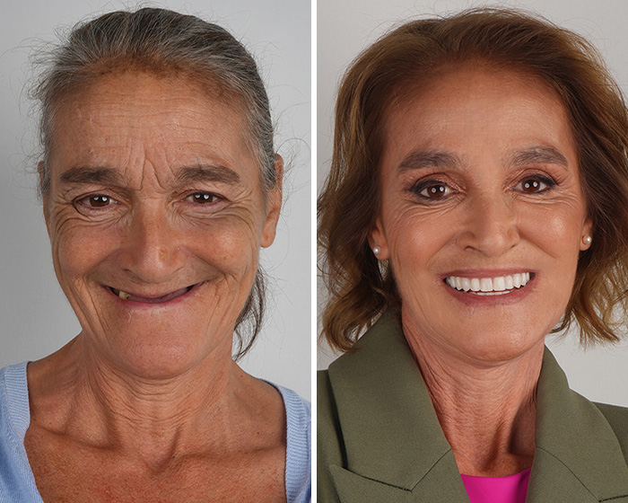 10 Jaw-Dropping Before-And-After Collages Of Women Who Underwent Extensive Smile Makeovers 10 Jaw-Dropping Before-And-After Collages Of Women Who Underwent Extensive Smile Makeovers