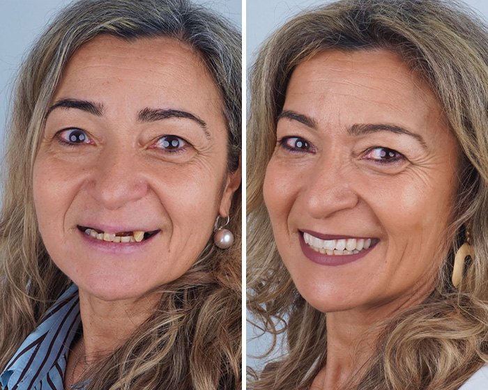 10 Jaw-Dropping Before-And-After Collages Of Women Who Underwent Extensive Smile Makeovers 10 Jaw-Dropping Before-And-After Collages Of Women Who Underwent Extensive Smile Makeovers