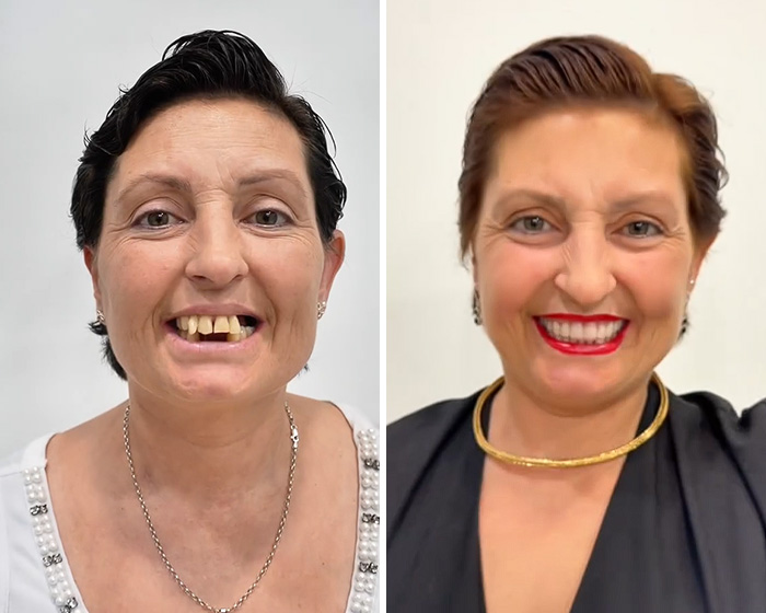 10 Jaw-Dropping Before-And-After Collages Of Women Who Underwent Extensive Smile Makeovers 10 Jaw-Dropping Before-And-After Collages Of Women Who Underwent Extensive Smile Makeovers
