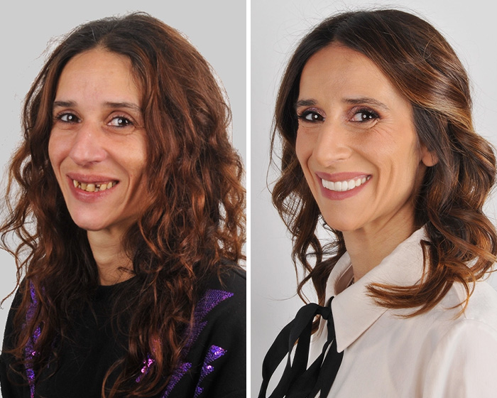 10 Jaw-Dropping Before-And-After Collages Of Women Who Underwent Extensive Smile Makeovers 10 Jaw-Dropping Before-And-After Collages Of Women Who Underwent Extensive Smile Makeovers