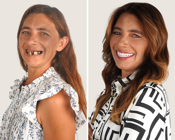 10 Jaw-Dropping Before-And-After Collages Of Women Who Underwent Extensive Smile Makeovers 10 Jaw-Dropping Before-And-After Collages Of Women Who Underwent Extensive Smile Makeovers