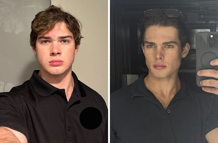 Looksmaxxer Clavicular Just Had His 3rd Surgery, And People Are Getting Concerned About His Transformation Looksmaxxer Clavicular Just Had His 3rd Surgery, And People Are Getting Concerned About His Transformation