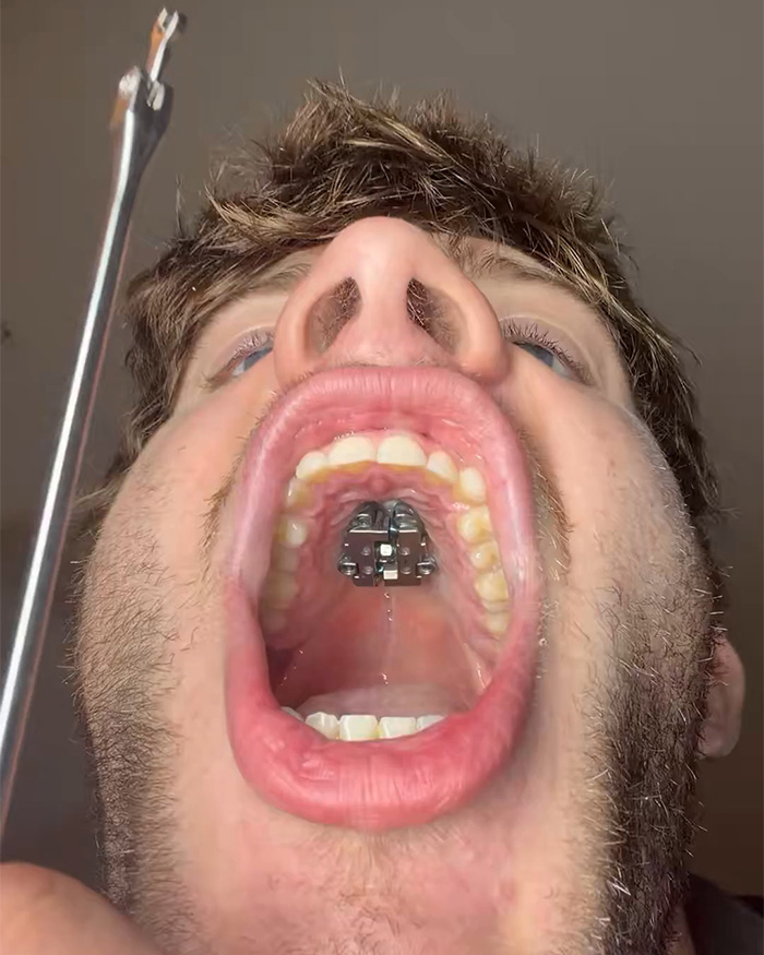 Doctor Warns Of The Risks After “Looksmaxxer” Films Himself Using A Maxilla Expander Doctor Warns Of The Risks After “Looksmaxxer” Films Himself Using A Maxilla Expander