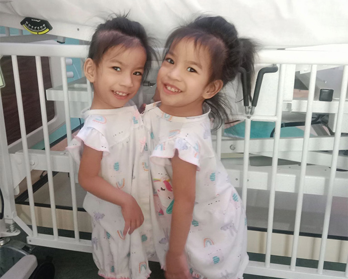 2-Year-Old Conjoined Twins Successfully Separated Following Grueling Six-Hour Surgery 2-Year-Old Conjoined Twins Successfully Separated Following Grueling Six-Hour Surgery