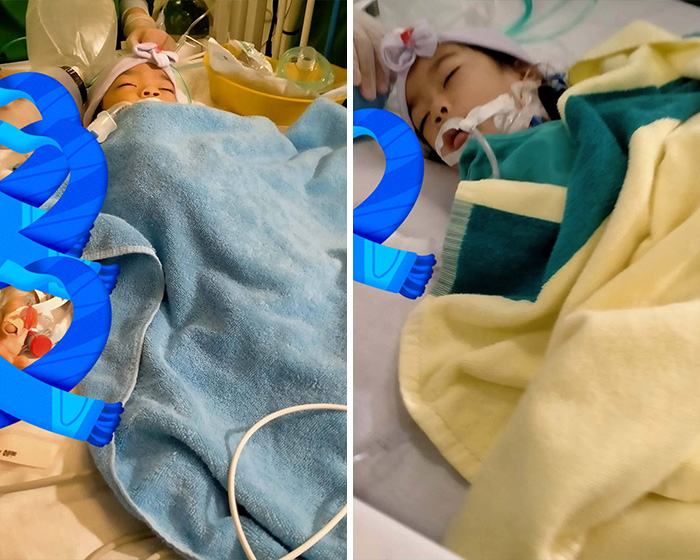 2-Year-Old Conjoined Twins Successfully Separated Following Grueling Six-Hour Surgery 2-Year-Old Conjoined Twins Successfully Separated Following Grueling Six-Hour Surgery