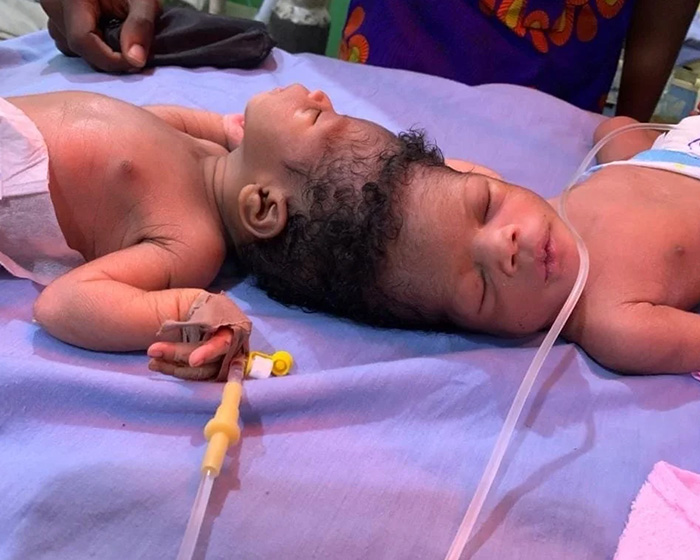 2-Year-Old Conjoined Twins Successfully Separated Following Grueling Six-Hour Surgery 2-Year-Old Conjoined Twins Successfully Separated Following Grueling Six-Hour Surgery