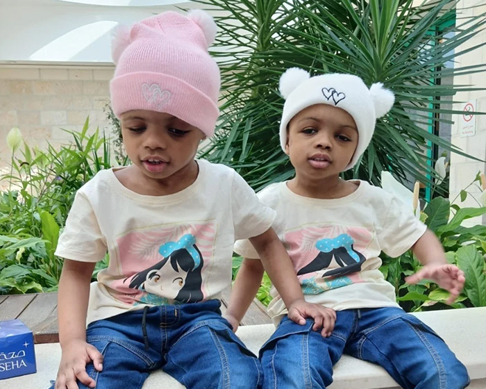 2-Year-Old Conjoined Twins Successfully Separated Following Grueling Six-Hour Surgery 2-Year-Old Conjoined Twins Successfully Separated Following Grueling Six-Hour Surgery