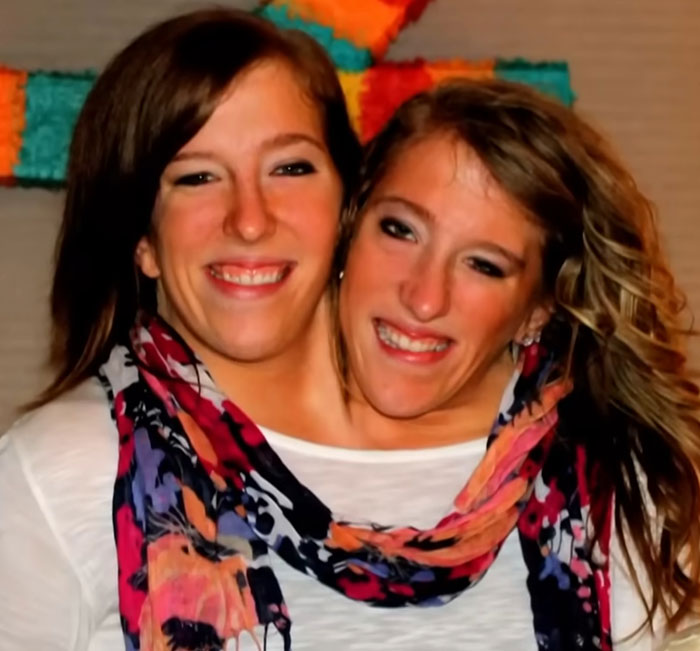 2-Year-Old Conjoined Twins Successfully Separated Following Grueling Six-Hour Surgery 2-Year-Old Conjoined Twins Successfully Separated Following Grueling Six-Hour Surgery