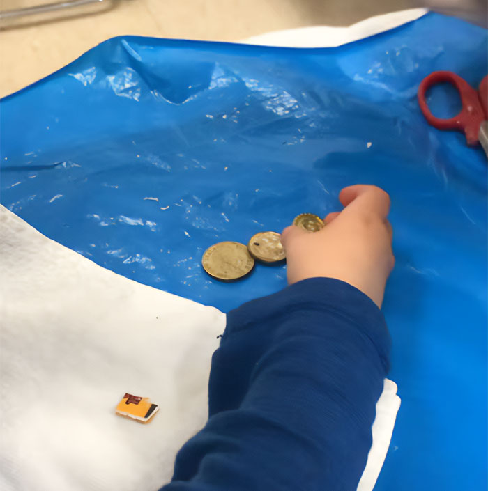 Doctor Discovers Jaw‑Dropping Surprise Hidden In Four‑Year‑Old Boy&rsquo;s Plaster Cast