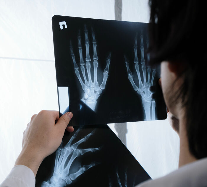 Doctor Discovers Jaw‑Dropping Surprise Hidden In Four‑Year‑Old Boy&rsquo;s Plaster Cast