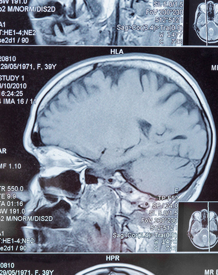 Man’s Suspected Brain Cancer Turns Into A Horror Story As Medical Team Uncovers Something Far Creepier Man’s Suspected Brain Cancer Turns Into A Horror Story As Medical Team Uncovers Something Far Creepier