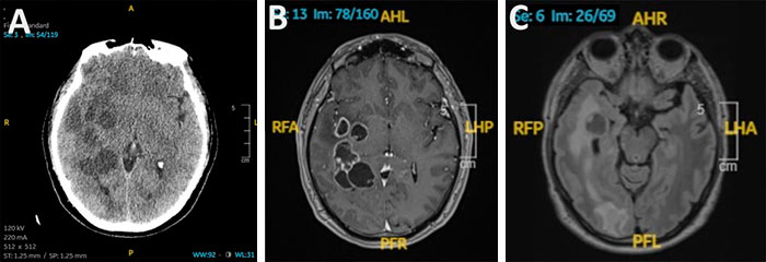 Man’s Suspected Brain Cancer Turns Into A Horror Story As Medical Team Uncovers Something Far Creepier Man’s Suspected Brain Cancer Turns Into A Horror Story As Medical Team Uncovers Something Far Creepier