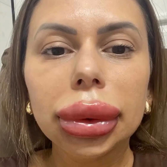 Woman’s Cosmetic Procedure Goes Viral As Her Face Changes Dramatically, Expert Weighs In And Explains The Risks Woman’s Cosmetic Procedure Goes Viral As Her Face Changes Dramatically, Expert Weighs In And Explains The Risks