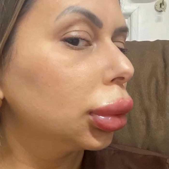 Woman’s Cosmetic Procedure Goes Viral As Her Face Changes Dramatically, Expert Weighs In And Explains The Risks Woman’s Cosmetic Procedure Goes Viral As Her Face Changes Dramatically, Expert Weighs In And Explains The Risks