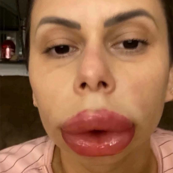 Woman’s Cosmetic Procedure Goes Viral As Her Face Changes Dramatically, Expert Weighs In And Explains The Risks Woman’s Cosmetic Procedure Goes Viral As Her Face Changes Dramatically, Expert Weighs In And Explains The Risks