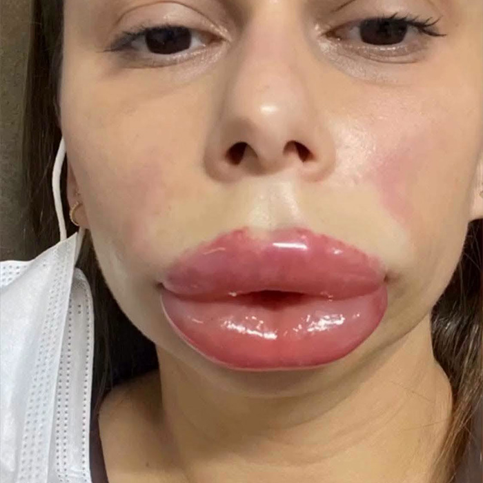 Woman’s Cosmetic Procedure Goes Viral As Her Face Changes Dramatically, Expert Weighs In And Explains The Risks Woman’s Cosmetic Procedure Goes Viral As Her Face Changes Dramatically, Expert Weighs In And Explains The Risks