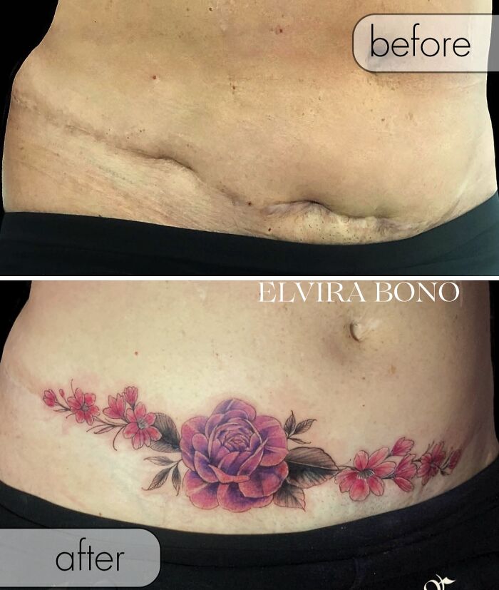 30 Scar Cover-Up Tattoos By Elvira Bono That Help People Feel Comfortable In Their Skin Again 30 Scar Cover-Up Tattoos By Elvira Bono That Help People Feel Comfortable In Their Skin Again