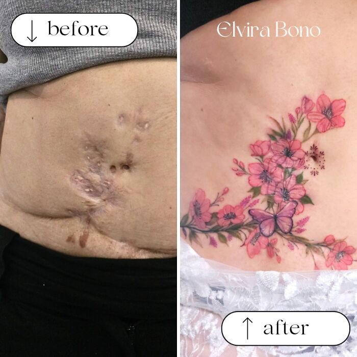 30 Scar Cover-Up Tattoos By Elvira Bono That Help People Feel Comfortable In Their Skin Again 30 Scar Cover-Up Tattoos By Elvira Bono That Help People Feel Comfortable In Their Skin Again