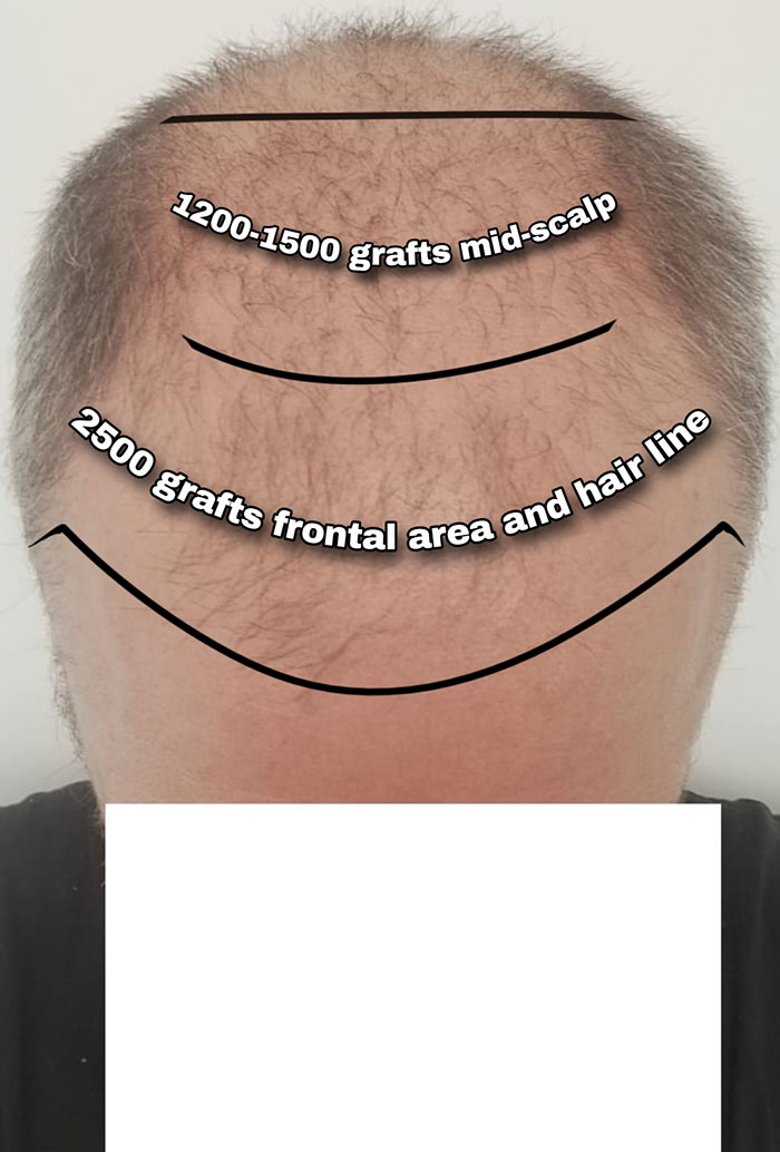 Hair Transplants Carry A Life-Changing Risk That Nobody Is Talking About Hair Transplants Carry A Life-Changing Risk That Nobody Is Talking About