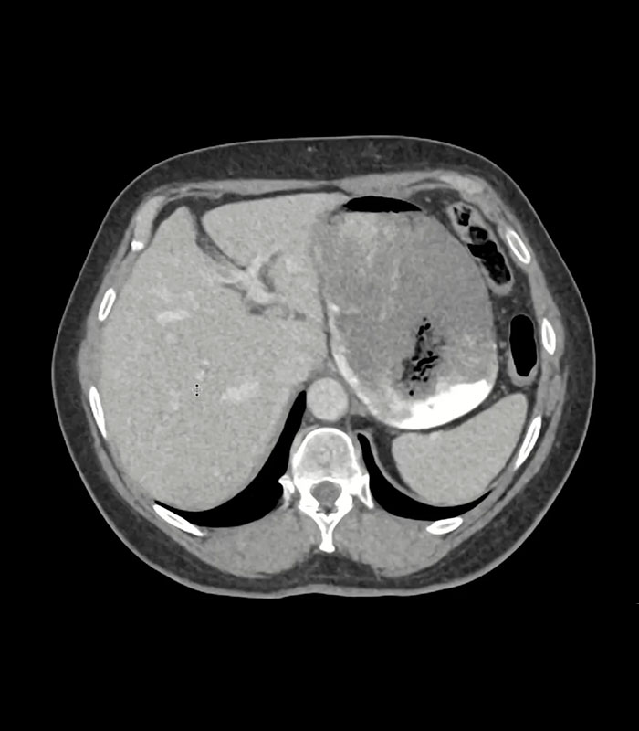 Woman&rsquo;s Stomach Condition Was Finally Cured After Doctors Said The Treatment Was Liters Of Diet Coke