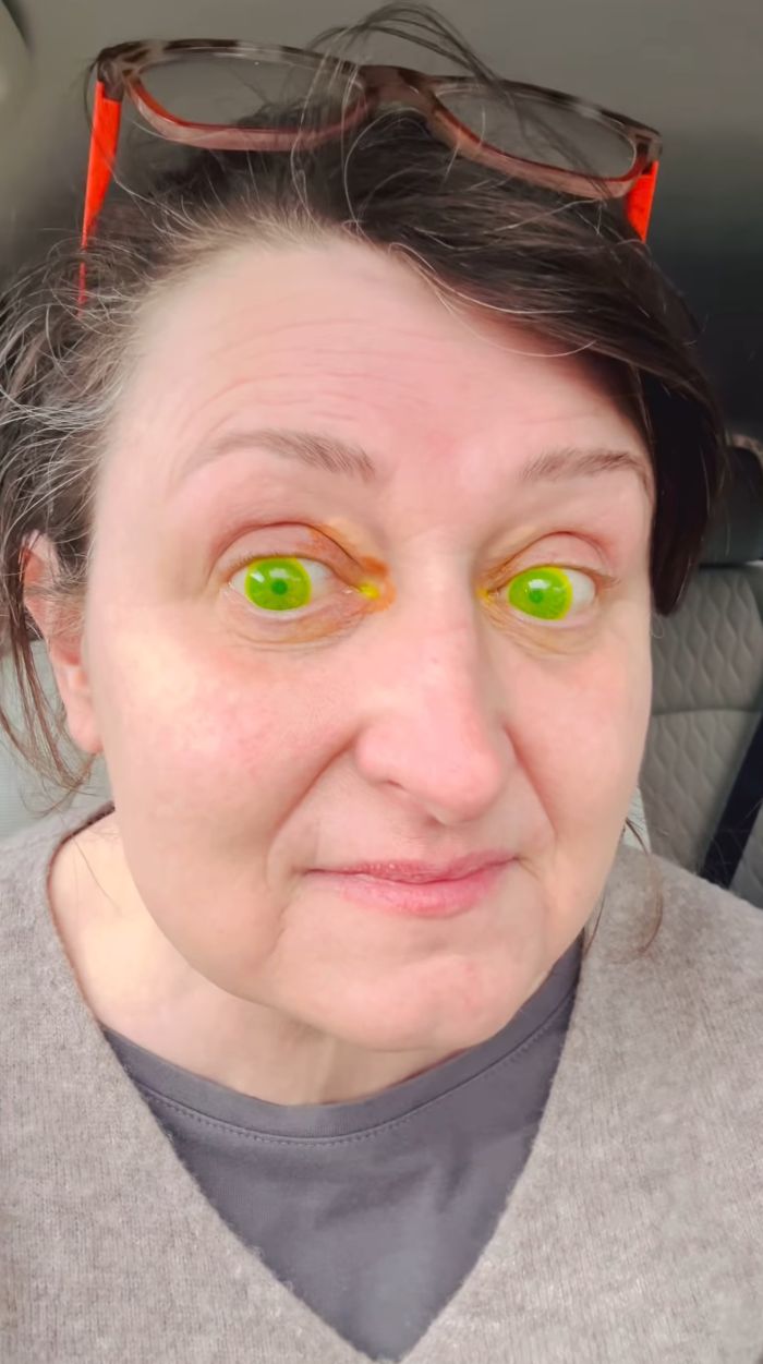 Woman Horrified After Her Pupils Turn Fluorescent Green During Routine Eye Exam, Experts Explain What Happened Woman Horrified After Her Pupils Turn Fluorescent Green During Routine Eye Exam, Experts Explain What Happened