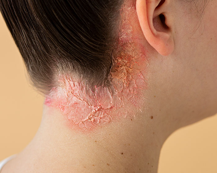 Dermatologist Reveals The Major Red Flag On Your Skin That Could Signal Heart Problems Dermatologist Reveals The Major Red Flag On Your Skin That Could Signal Heart Problems