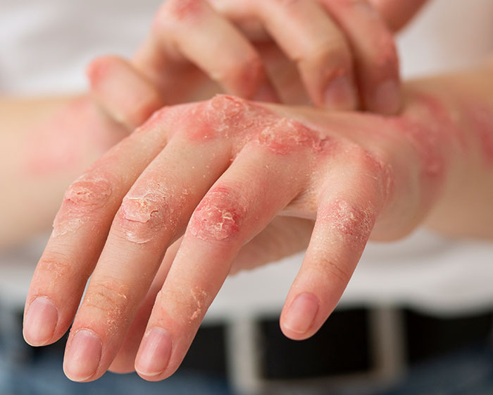 Dermatologist Reveals The Major Red Flag On Your Skin That Could Signal Heart Problems Dermatologist Reveals The Major Red Flag On Your Skin That Could Signal Heart Problems