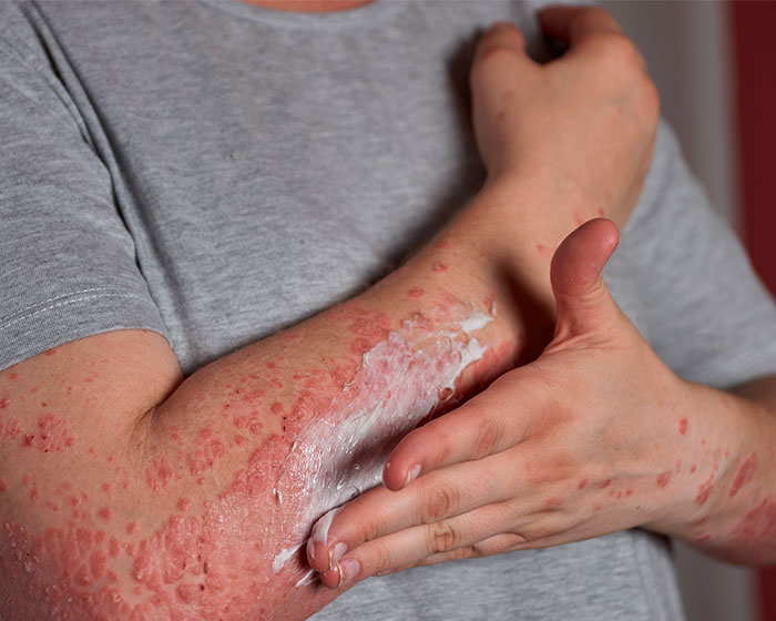 Dermatologist Reveals The Major Red Flag On Your Skin That Could Signal Heart Problems Dermatologist Reveals The Major Red Flag On Your Skin That Could Signal Heart Problems