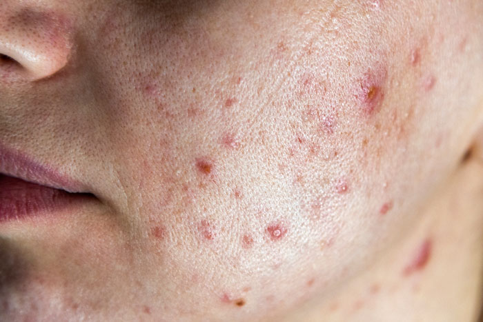 Millions Of Teens Take This Acne Pill. Some Say It Nearly Cost Them Their Lives &mdash; And No One Warned Them