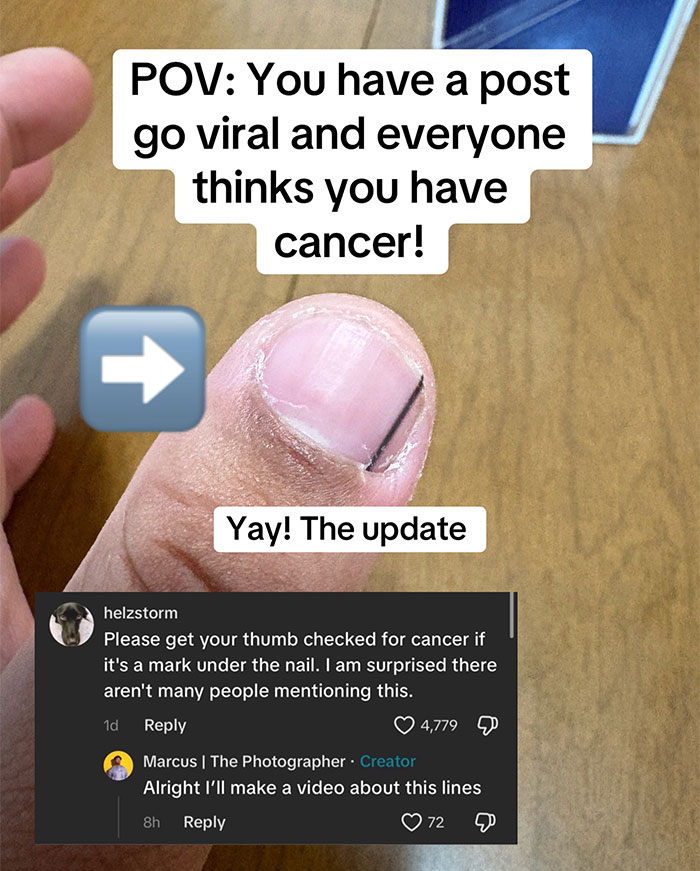 Man’s Viral Costco Chicken Clip Sparks Concern As Viewers Notice Dark Nail Stripe, Expert Explains What It Means Man’s Viral Costco Chicken Clip Sparks Concern As Viewers Notice Dark Nail Stripe, Expert Explains What It Means