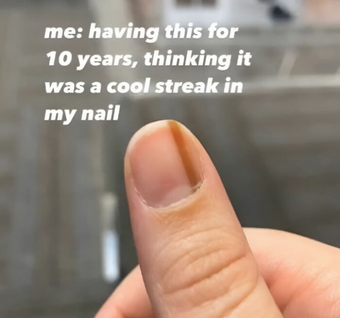 Man’s Viral Costco Chicken Clip Sparks Concern As Viewers Notice Dark Nail Stripe, Expert Explains What It Means Man’s Viral Costco Chicken Clip Sparks Concern As Viewers Notice Dark Nail Stripe, Expert Explains What It Means