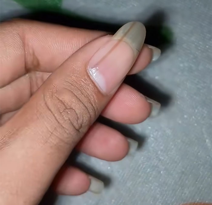 Man’s Viral Costco Chicken Clip Sparks Concern As Viewers Notice Dark Nail Stripe, Expert Explains What It Means Man’s Viral Costco Chicken Clip Sparks Concern As Viewers Notice Dark Nail Stripe, Expert Explains What It Means