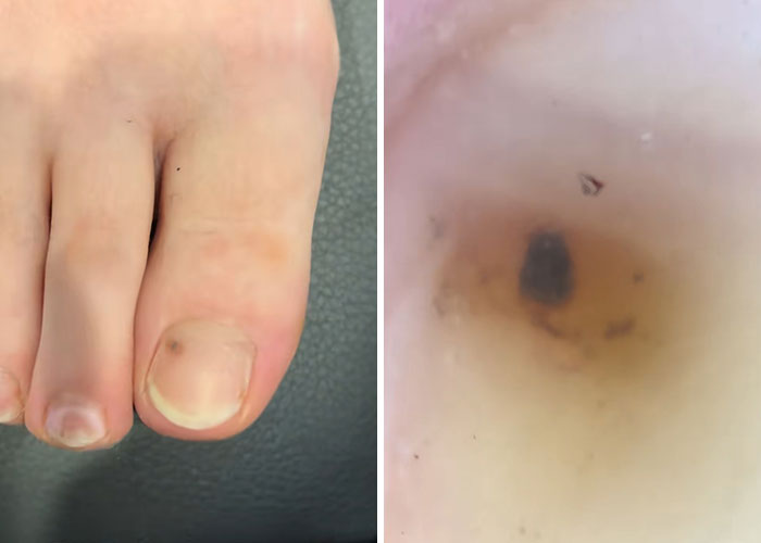 Man’s Viral Costco Chicken Clip Sparks Concern As Viewers Notice Dark Nail Stripe, Expert Explains What It Means Man’s Viral Costco Chicken Clip Sparks Concern As Viewers Notice Dark Nail Stripe, Expert Explains What It Means