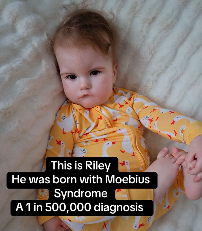 Mom Knew Something Was Wrong When Her Baby Couldn’t Form Expressions, Then Doctors Discovered A Rare Condition Mom Knew Something Was Wrong When Her Baby Couldn’t Form Expressions, Then Doctors Discovered A Rare Condition