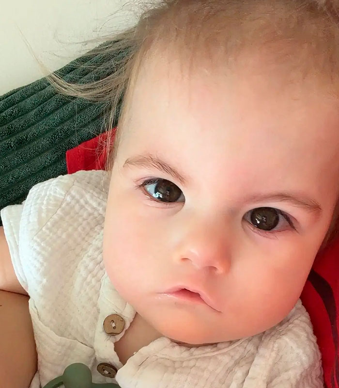 Mom Knew Something Was Wrong When Her Baby Couldn’t Form Expressions, Then Doctors Discovered A Rare Condition Mom Knew Something Was Wrong When Her Baby Couldn’t Form Expressions, Then Doctors Discovered A Rare Condition