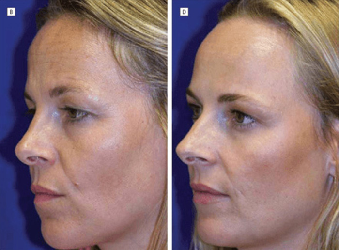 Identical Twins Show Dramatic Differences After One Uses Botox For 20 Years And The Other Doesn’t Identical Twins Show Dramatic Differences After One Uses Botox For 20 Years And The Other Doesn’t