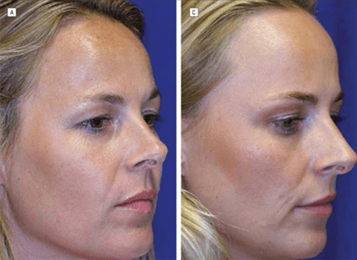 Identical Twins Show Dramatic Differences After One Uses Botox For 20 Years And The Other Doesn’t Identical Twins Show Dramatic Differences After One Uses Botox For 20 Years And The Other Doesn’t