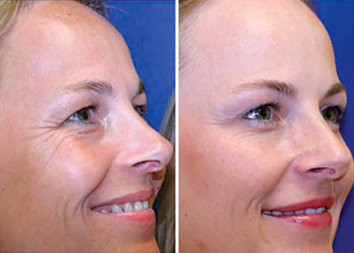 Identical Twins Show Dramatic Differences After One Uses Botox For 20 Years And The Other Doesn’t Identical Twins Show Dramatic Differences After One Uses Botox For 20 Years And The Other Doesn’t