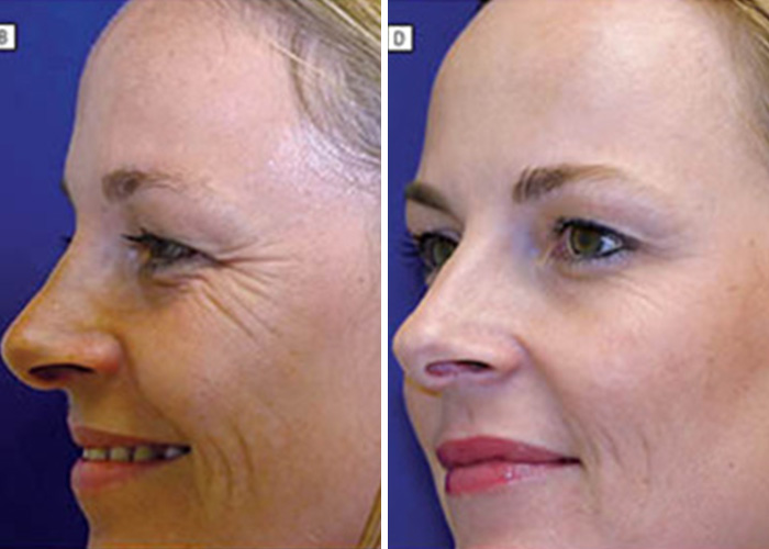 Identical Twins Show Dramatic Differences After One Uses Botox For 20 Years And The Other Doesn’t Identical Twins Show Dramatic Differences After One Uses Botox For 20 Years And The Other Doesn’t