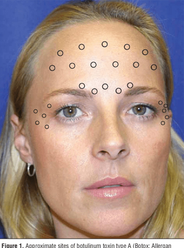 Identical Twins Show Dramatic Differences After One Uses Botox For 20 Years And The Other Doesn’t Identical Twins Show Dramatic Differences After One Uses Botox For 20 Years And The Other Doesn’t