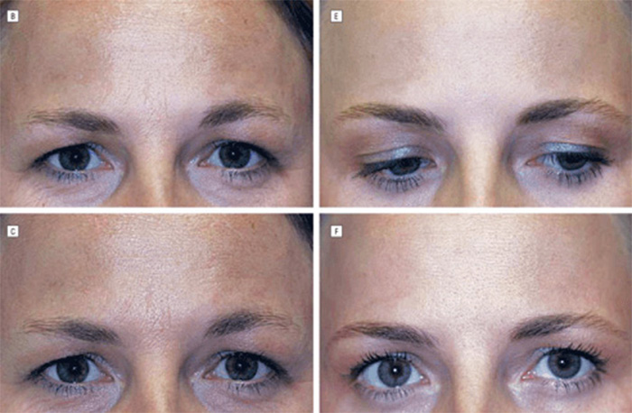 Identical Twins Show Dramatic Differences After One Uses Botox For 20 Years And The Other Doesn’t Identical Twins Show Dramatic Differences After One Uses Botox For 20 Years And The Other Doesn’t