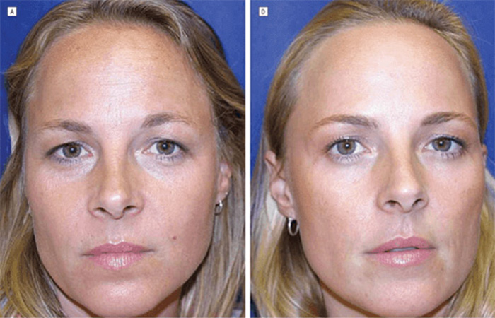 Identical Twins Show Dramatic Differences After One Uses Botox For 20 Years And The Other Doesn’t Identical Twins Show Dramatic Differences After One Uses Botox For 20 Years And The Other Doesn’t