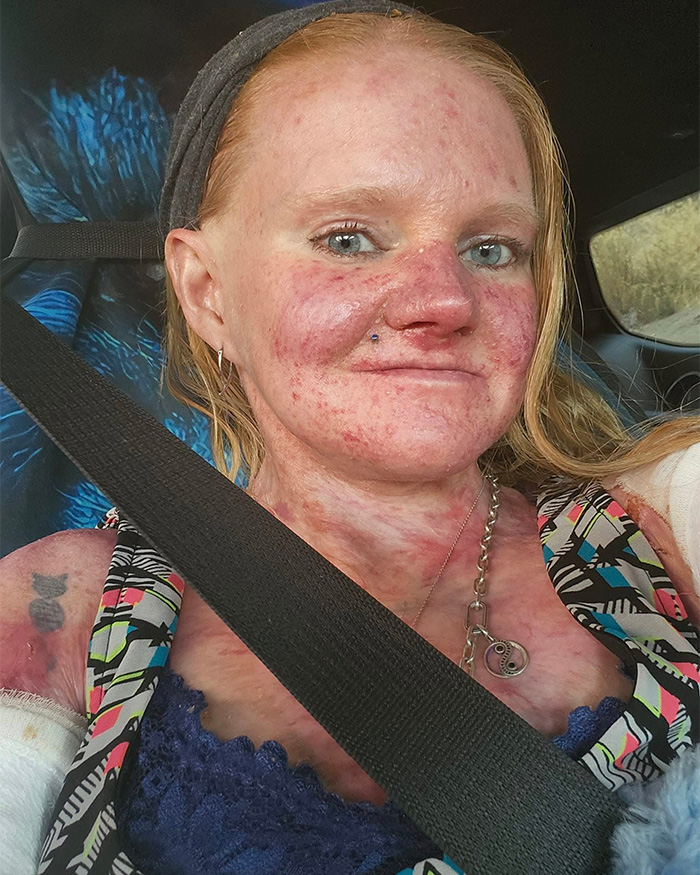 Woman With One Of The World’s Rarest Skin Conditions Details Extreme Measures To Protect Herself Woman With One Of The World’s Rarest Skin Conditions Details Extreme Measures To Protect Herself