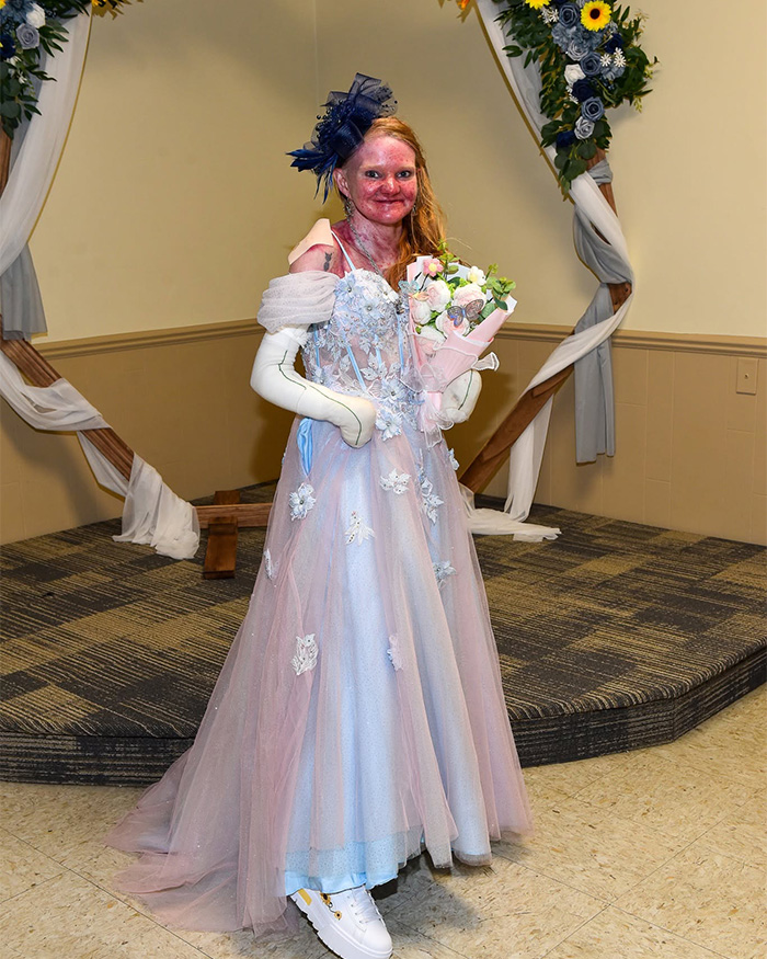 Woman With One Of The World’s Rarest Skin Conditions Details Extreme Measures To Protect Herself Woman With One Of The World’s Rarest Skin Conditions Details Extreme Measures To Protect Herself