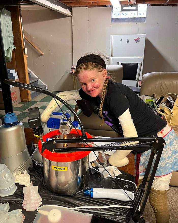 Woman With One Of The World’s Rarest Skin Conditions Details Extreme Measures To Protect Herself Woman With One Of The World’s Rarest Skin Conditions Details Extreme Measures To Protect Herself